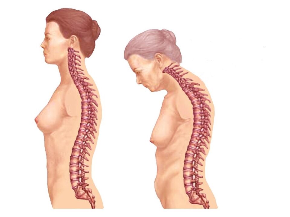 здоровый искривленный позвоночник при остеохондрозе